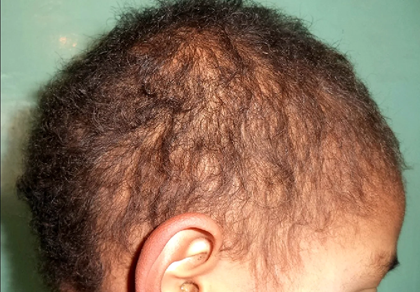 Веретенообразная аплазия волос монилетрикс