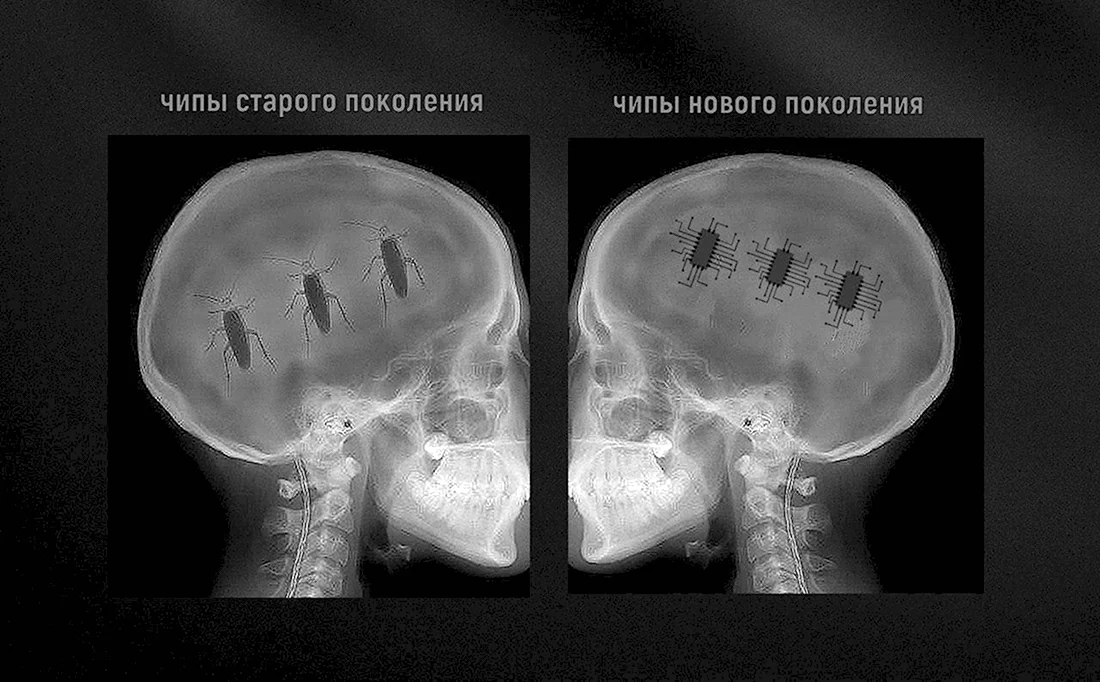 Чип в голове рентгеновский снимок
