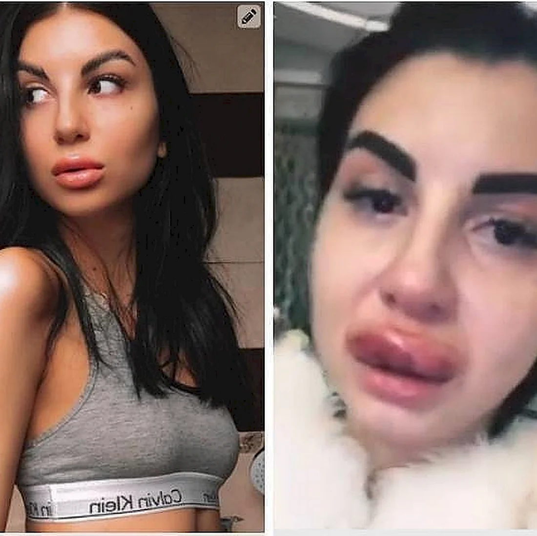 Девушки с накаченными губами до и после красивые