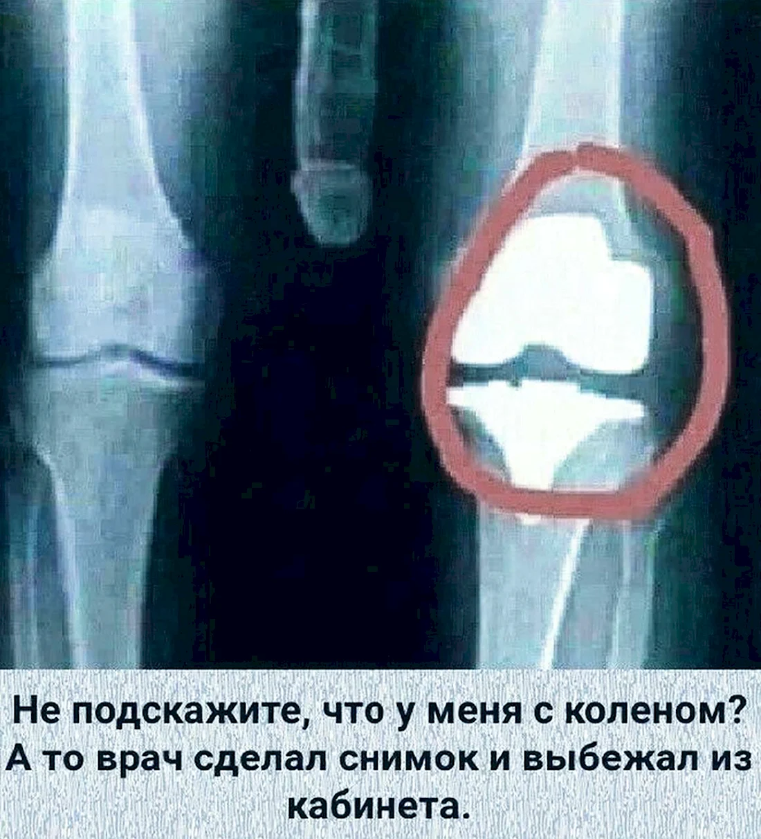 Рентген коленного сустава прикол