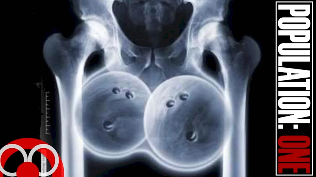 Рентгеновские снимки яичек