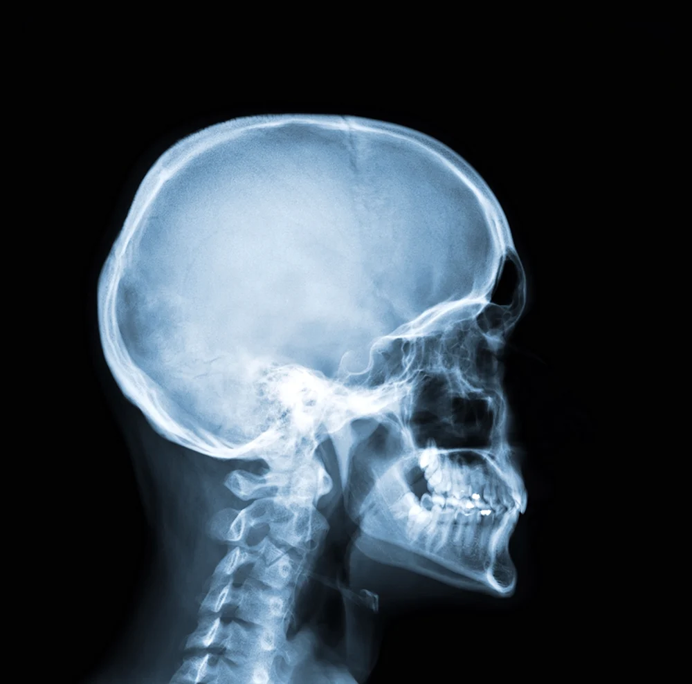 Рентгеновский снимок черепа
