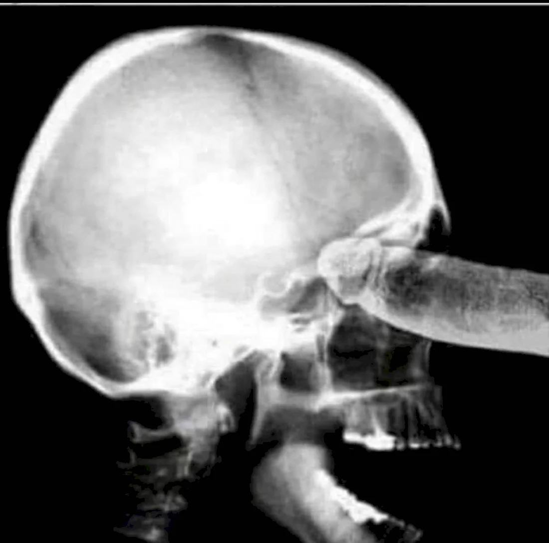 Рентгеновский снимок члена