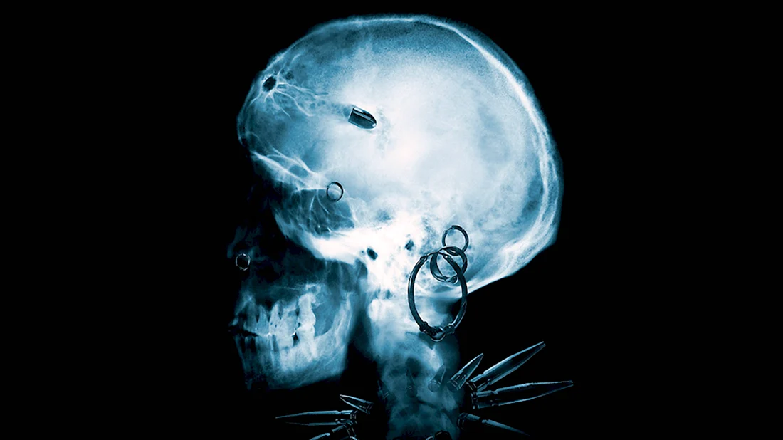 Снимок черепа с пулей в голове